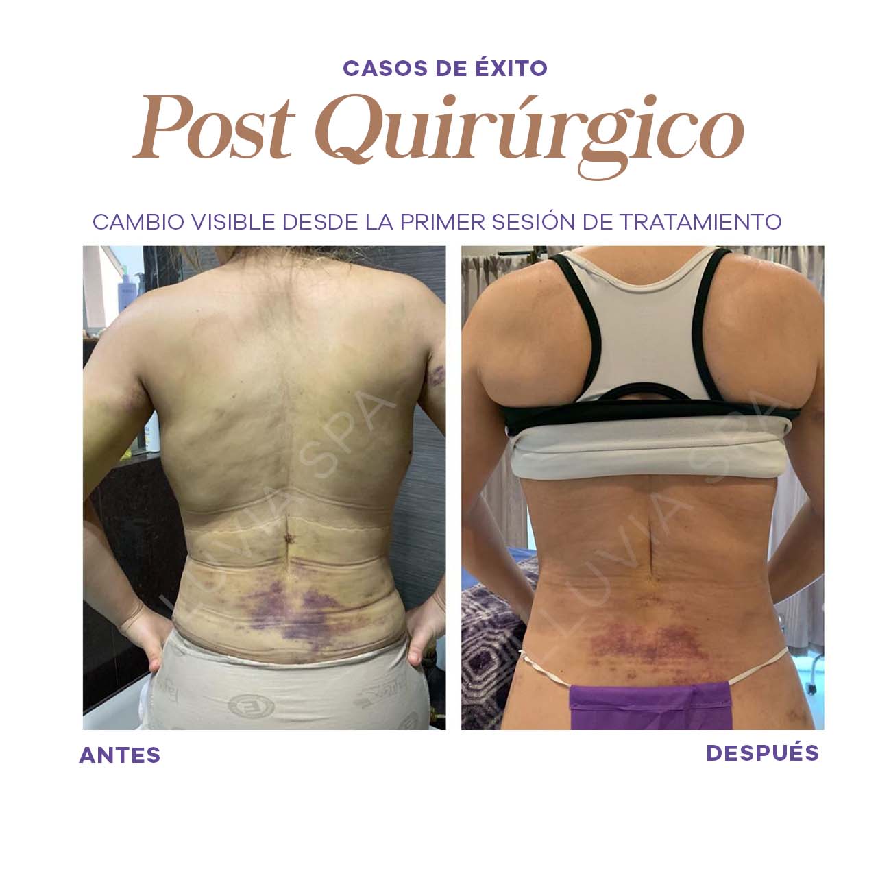 Post Quirúrgico – Lluvia Spa